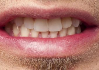 روش های توقف و درمان دندان قروچه | بهترین دندانپزشک اصفهان