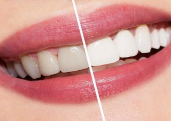 عوارض کیت و محصولات سفید کننده دندان | بهترین ایمپلنت اصفهان