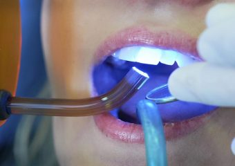 مزایای کامپوزیت دندان | بهترین دندانپزشک زیبایی اصفهان