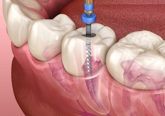 نحوه انجام عصب کشی دندان | بهترین دندانپزشک زیبایی اصفهان
