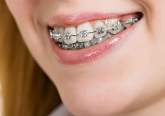 اتصال دستگاه های ارتونسی درد دارد؟ | بهترین دندانپزشک زیبایی