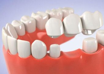 اسکلت فلزی با روکش دندان سرامیکی | بهترین دندانپزشک زیبایی