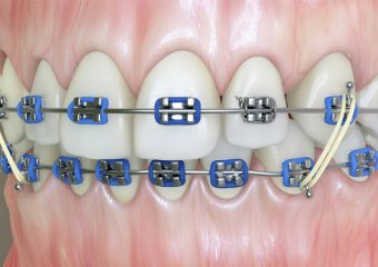 روش های کاهش درد اتودنسی | بهترین دندانپزشک زیبایی