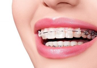 زرد شدن دندان بعد از ارتودنسی | بهترین دندانپزشک زیبایی