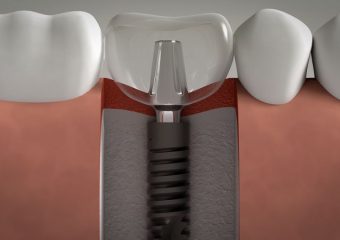 ملاک های کاندید مناسب جهت کاشت دندان | بهترین ایمپلنت اصفهان