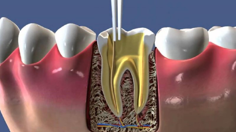 چگونگی انجام عصب کشی دندان | بهترین دندانپزشک زیبایی