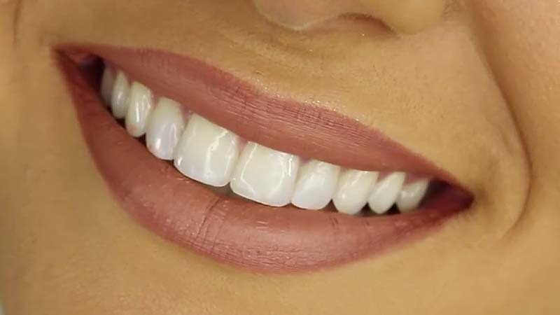 اجزای زیبایی شناختی اصلاح طرح لبخند | بهترین ایمپلنت اصفهان