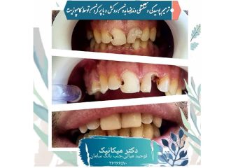 بازسازی دندان های شکسته و پوسیده با کامپوزیت | بهترین دندانپزشک اصفهان