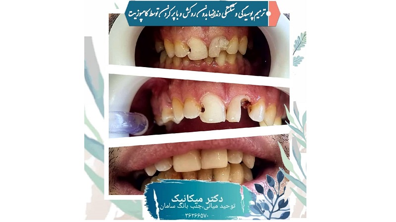 بازسازی دندان های شکسته و پوسیده با کامپوزیت | بهترین دندانپزشک اصفهان