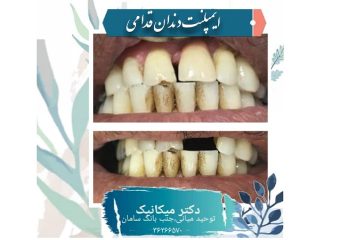 بازسازی دندان های قدامی با ایمپلنت | بهترین دندانپزشک اصفهان