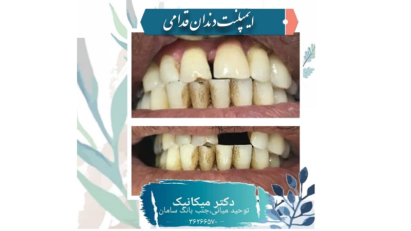 بازسازی دندان های قدامی با ایمپلنت | بهترین دندانپزشک اصفهان
