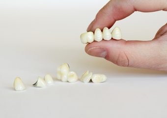 بررسی انواع تاج دندان | بهترین دندانپزشک اصفهان