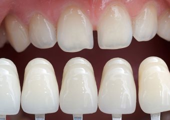 بررسی معایب و عوارض لمینت دندان | بهترین ایمپلنت اصفهان