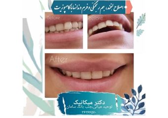ترمیم با کامپوزیت و اصلاح طرح لبخند | بهترین دندانپزشک اصفهان