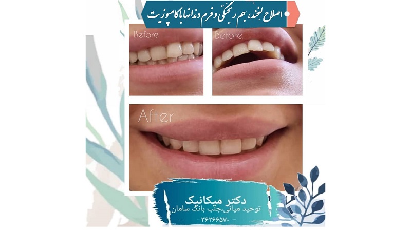 ترمیم با کامپوزیت و اصلاح طرح لبخند | بهترین دندانپزشک اصفهان