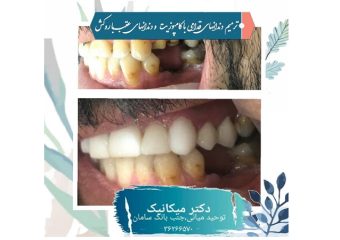 ترمیم دندان های قدامی بوسیله کامپوزیت دندان ها | بهترین دندانپزشک اصفهان