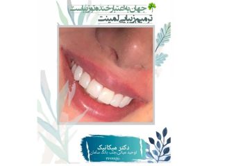ترمیم زیبایی لمینت دندان | بهترین دندانپزشک اصفهان