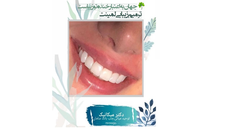 ترمیم زیبایی لمینت دندان | بهترین دندانپزشک اصفهان