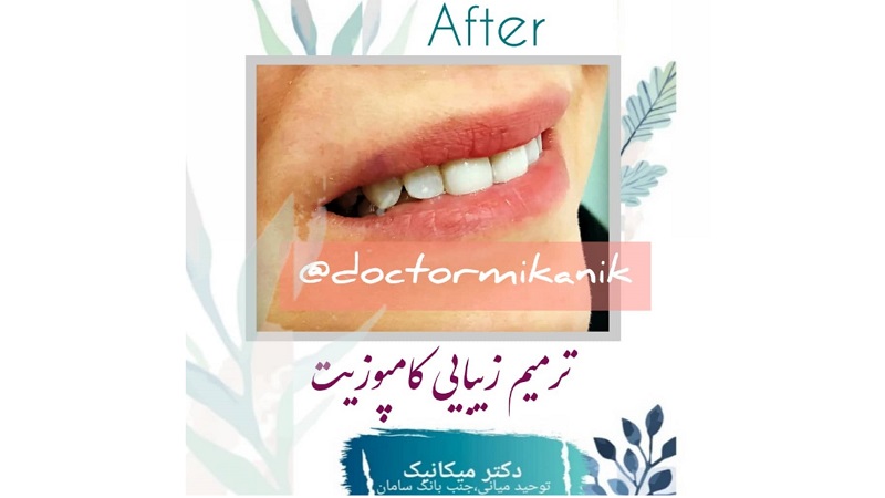 ترمیم زیبایی کامپوزیت | بهترین دندانپزشک اصفهان