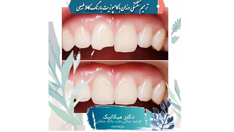 ترمیم شکستگی دندان با کامپوزیت | بهترین دندانپزشک اصفهان