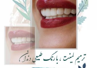 ترمیم لمینت، با رنگ طبیعی دندان | بهترین ایمپلنت اصفهان