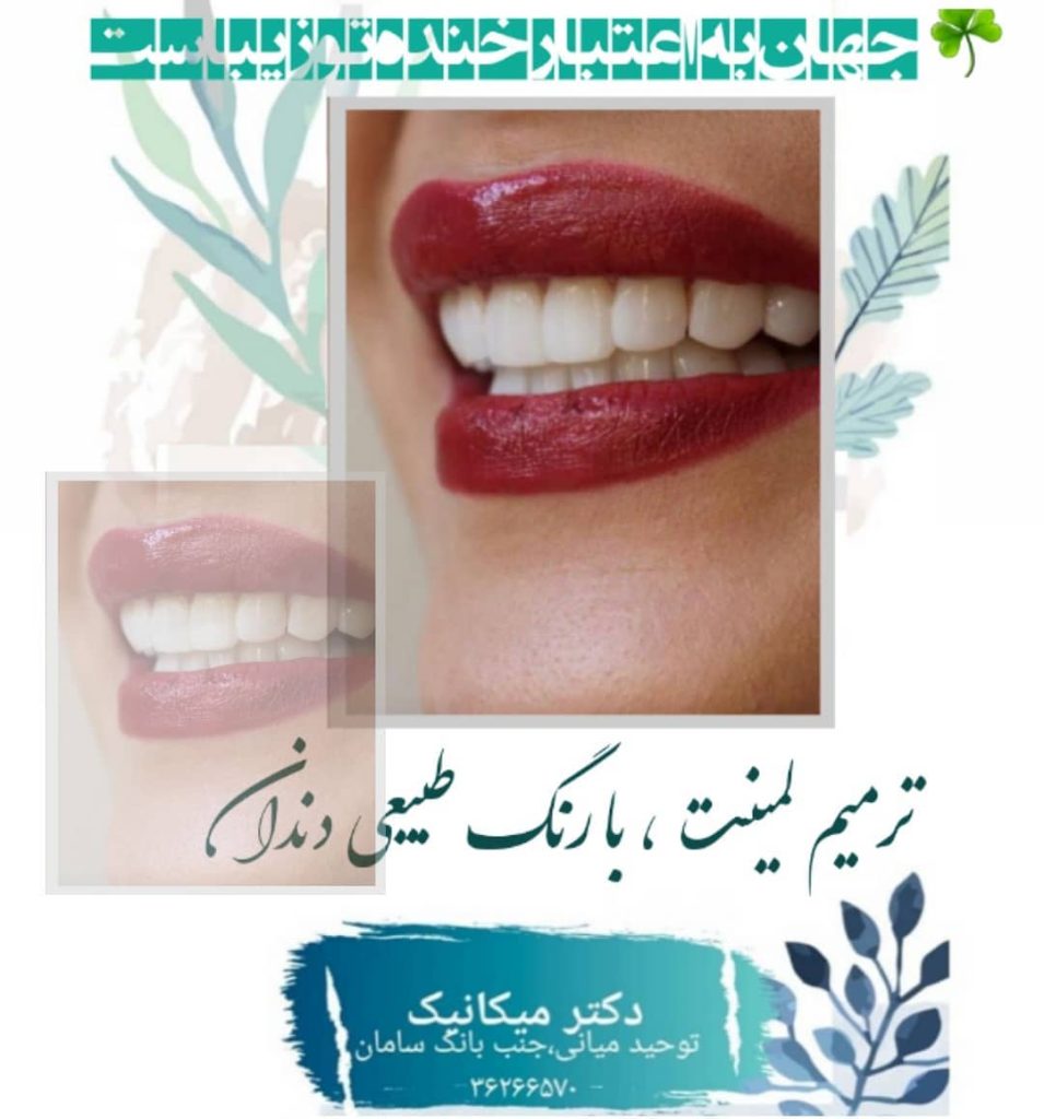 ترمیم لمینت، با رنگ طبیعی دندان | بهترین ایمپلنت اصفهان