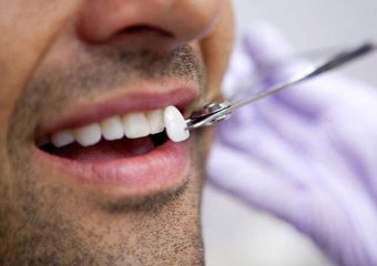 روش های جلوگیری از بروز عوارض لمینت دندان | بهترین ایمپلنت اصفهان