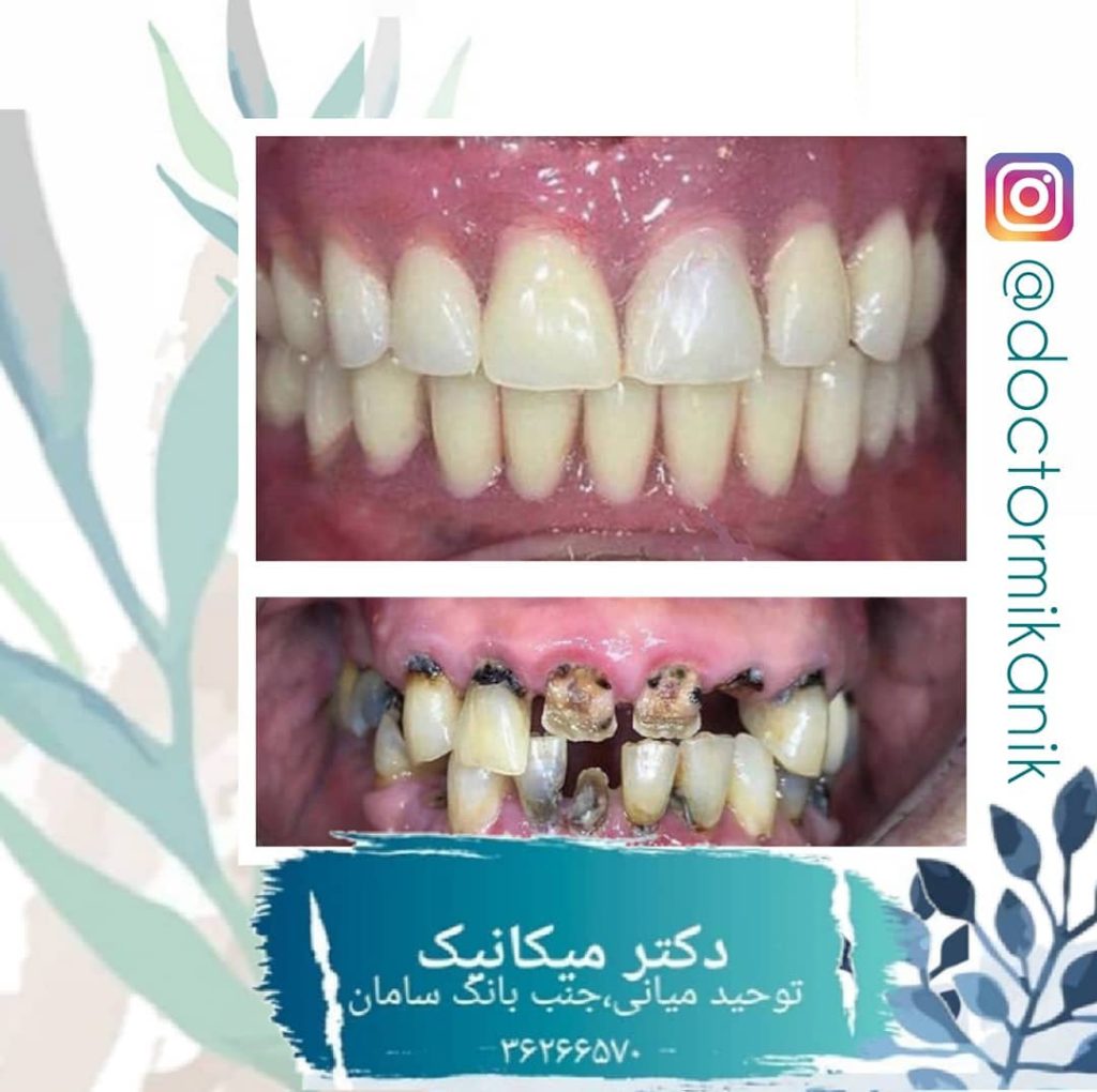 عصب کشی و درمانهای ترمیمی مناسب | بهترین ایمپلنت اصفهان