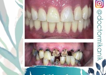 عصب کشی و درمانهای ترمیمی مناسب | بهترین ایمپلنت اصفهان