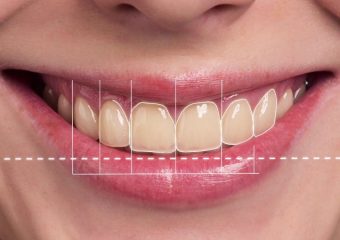 بهترین ایمپلنت اصفهان | بهترین دندانپزشک زیبایی اصفهان | دکتر ندا مکانیک | علل و روش های اصلاح طرح لبخند | بهترین ایمپلنت اصفهان