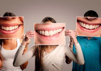 مراحل بلیچینگ دندان در مطب دندانپزشکی | بهترین دندانپزشک زیبایی اصفهان