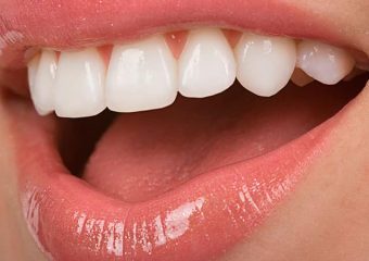 مزایا و خطرات لمینت سرامیکی دندان | بهترین دندانپزشک اصفهان