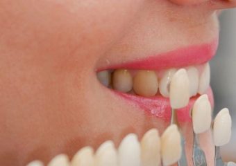 نحوه انجام لمینت سرامیکی دندان | بهترین ایمپلنت اصفهان