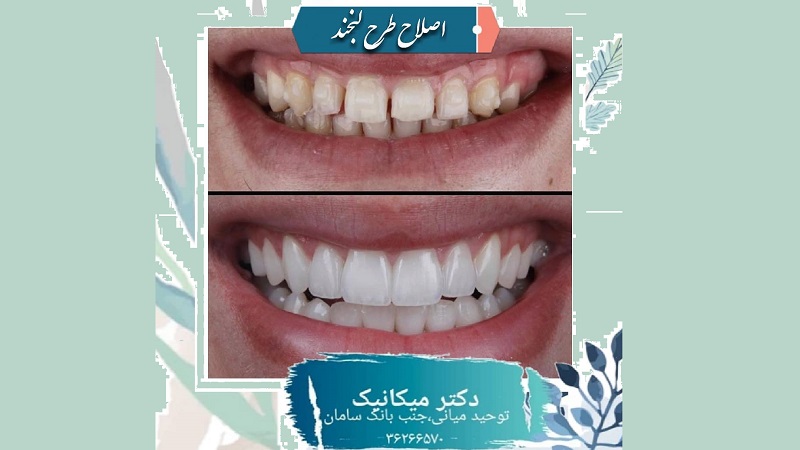 اصلاح طرح لبخند با رنگ و فرم طبیعی | بهترین ایمپلنت اصفهان