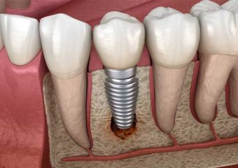 ایمپلنت دندان در سالمندان | بهترین دندانپزشک زیبایی اصفهان
