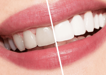 بررسی انواع لمینت های بدون تراش | بهترین ایمپلنت اصفهان