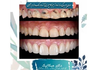 ترمیم زیبایی کامپوزیت با رنگ و فرم کاملا طبیعی | بهترین ایمپلنت اصفهان