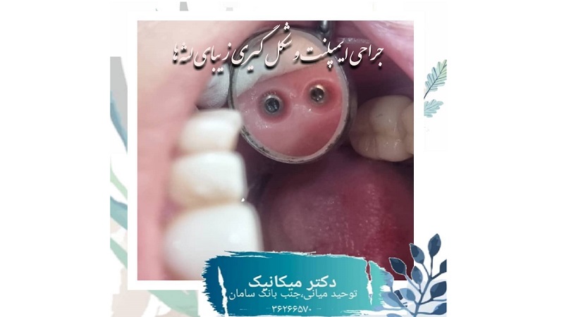 جراحی لثه برای کاشت ایمپلنت | بهترین ایمپلنت اصفهان