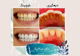 جرمگیری و بلیچینگ دندان | بهترین دندانپزشک زیبایی اصفهان