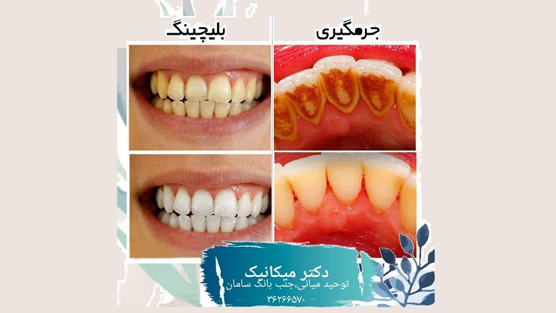 جرمگیری و بلیچینگ دندان | بهترین دندانپزشک زیبایی اصفهان