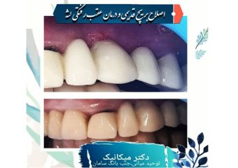 درمان تحلیل لثه و ترمیم بریج قدیمی | بهترین ایمپلنت اصفهان