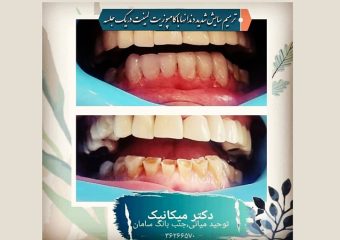 درمان سایش دندان با کامپوزیت لمینت | بهترین ایمپلنت اصفهان