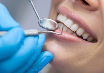 روش های ترمیم دندان شکسته | بهترین ایمپلنت اصفهان