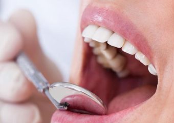 روش کرونکتومی برای درمان دندان آسیب دیده | بهترین دندانپزشک زیبایی اصفهان