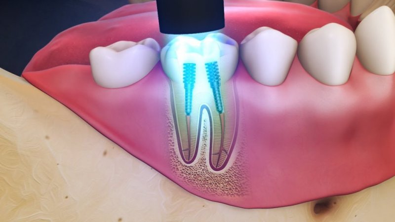 روش کرونکتومی برای درمان دندان آسیب دیده | بهترین دندانپزشک زیبایی اصفهان