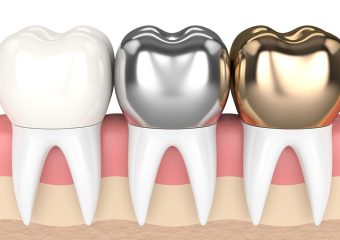 مزایا ، معایب و گزینه‌های جایگزین تاج دندان | بهترین دندانپزشک اصفهان