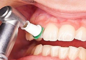 همه چیز راجع به بروساژ دندان | بهترین دندانپزشک زیبایی اصفهان