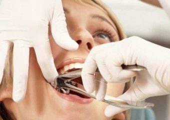 آشنایی با جراحی و کشیدن دندان عقل نهفته | بهترین دندانپزشک اصفهان