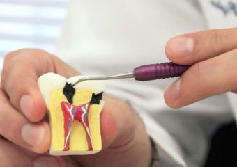 از عصب کشی دندان جلوگیری کنید | بهترین ایمپلنت اصفهان