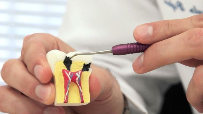از عصب کشی دندان جلوگیری کنید | بهترین ایمپلنت اصفهان